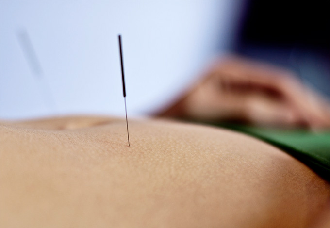 acupuncture for anxiety is proving effective