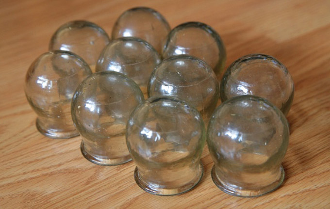 cupping - Traditional Chinese Medicine