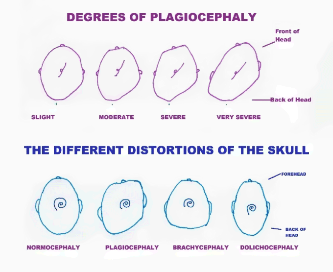 plagiocephaly and brachycephaly