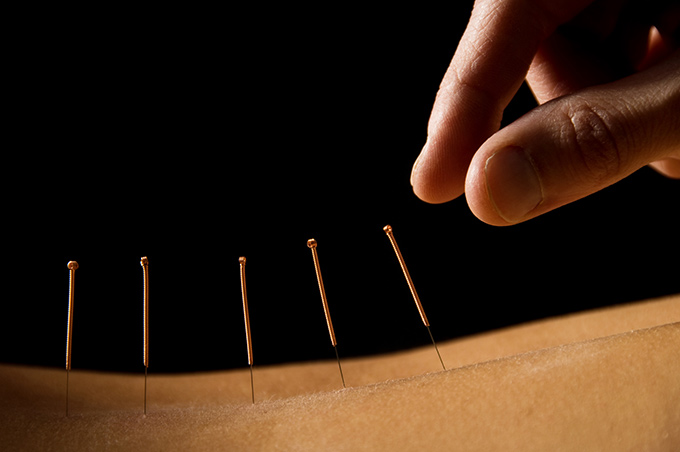 who is TCM and acupuncture for?