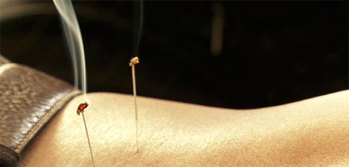 acupuncture for pregnant women