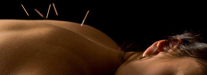 acupuncture on a woman