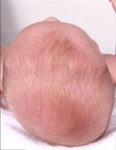 Baby with plagiocephaly