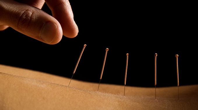 acupuncture for depression or Seasonal Affective Disorder can be effective