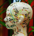 acupuncture for headaches