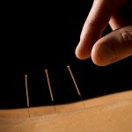 acupuncture for managing anxiety